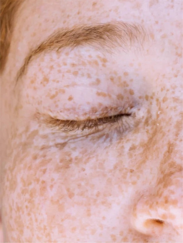 PigmentRemover-Sérum ciblé anti-taches
